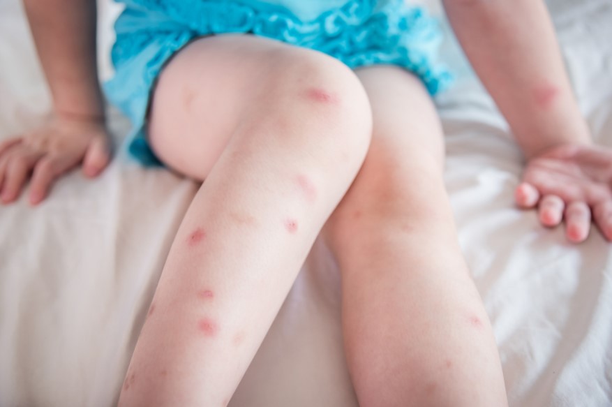 bed bug bite