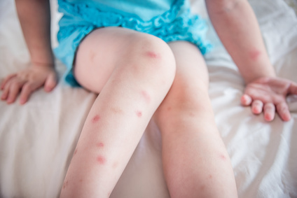 bed bug bites