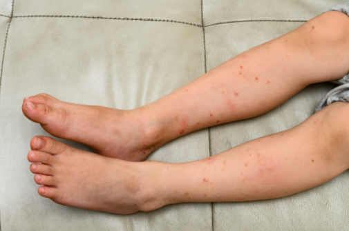 how pests affects children